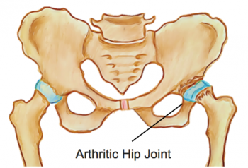 Osteoarthritis Of The Hip