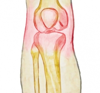 The Surprising Truth About Osteoarthritis
